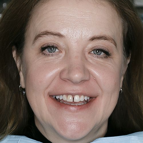 Maiely - composite veneers - before - Carmen - 3dental